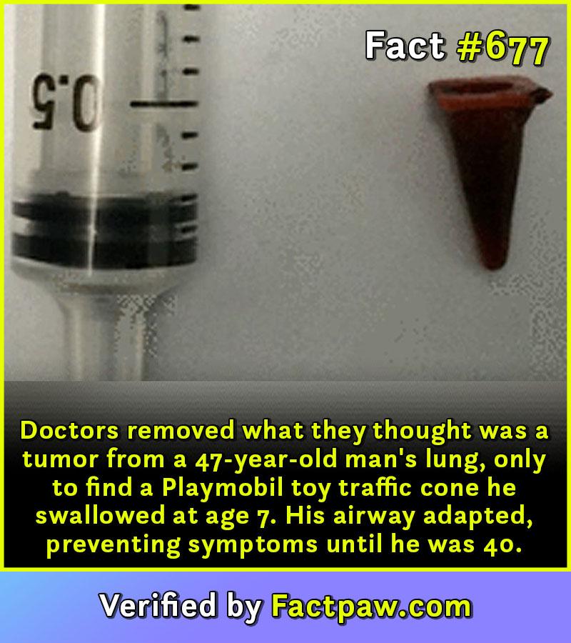 Doctors removed what they thought was a tumor from a 47-year-old man's lung, only to find a Playmobil toy traffic cone he swallowed at age 7. His airway adapted, preventing symptoms until he was 40.